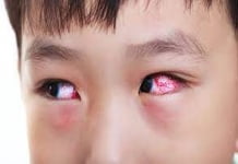 TP HCM gia tăng bệnh đau mắt đỏ