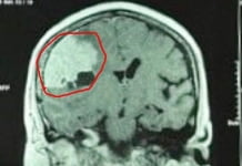 Phẫu thuật thành công u màng não to gần bằng quả lựu