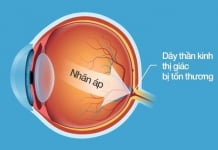 Mách bạn cách phát hiện sớm dấu hiệu căn bệnh gây giảm thị lực vĩnh viễn
