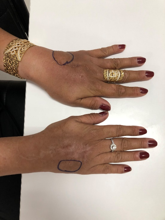 Người phụ nữ đau đớn sau 20 năm bơm silicon để được bàn tay “búp măng”